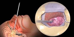 Chirurgie oncologique – prise en charge du cancer